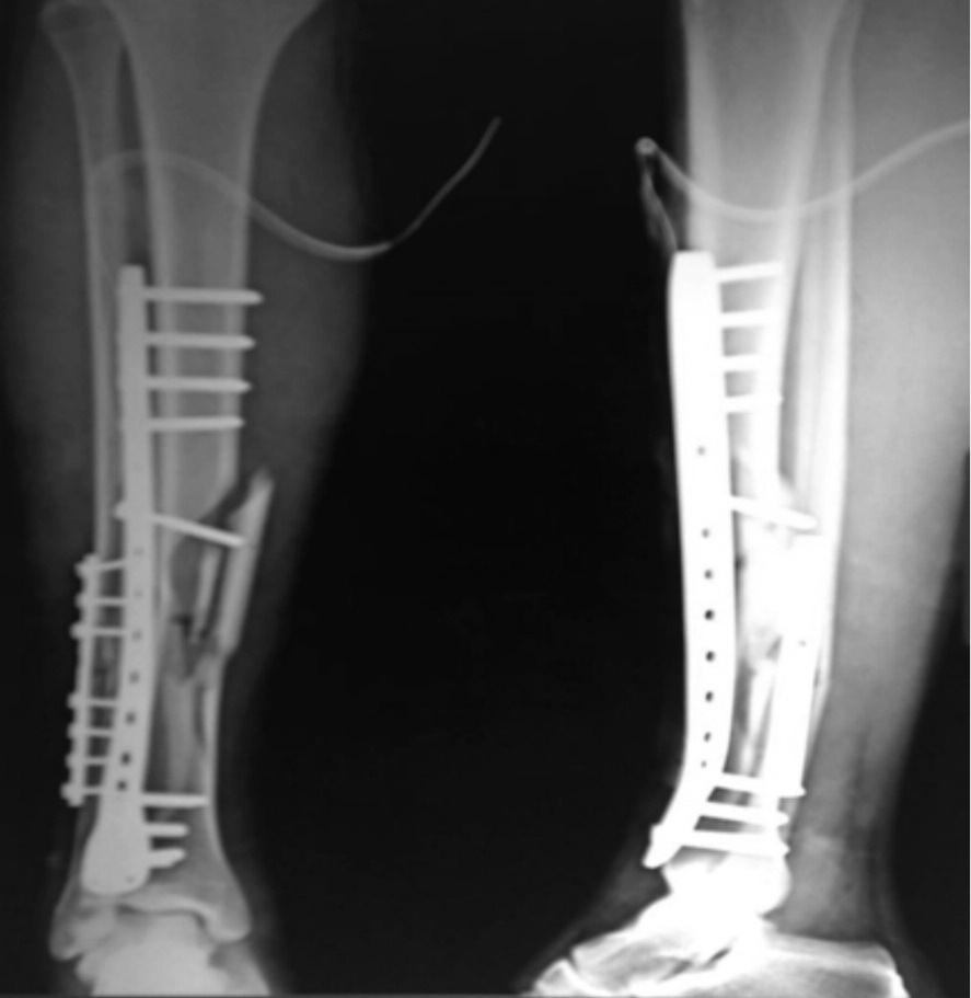 Range of movement of adjacent joints less than 30% of normal. Pain enough to cause severe disability or non union. Fig.