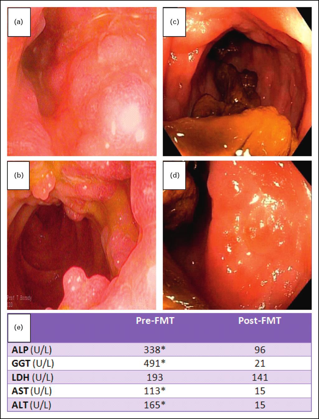 Large intestine FIGURE 1. Inflammatory bowel disease with concurrent sclerosing cholangitis pre and post-fmt.