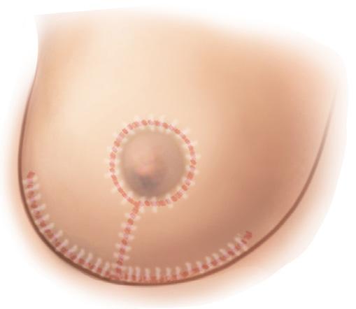 a b c Figure 1 a The excess fat and skin are removed b The breast is re-shaped and nipple is lifted c An anchor-shaped scar Your surgeon will usually insert drains (tubes) in the cuts to help your