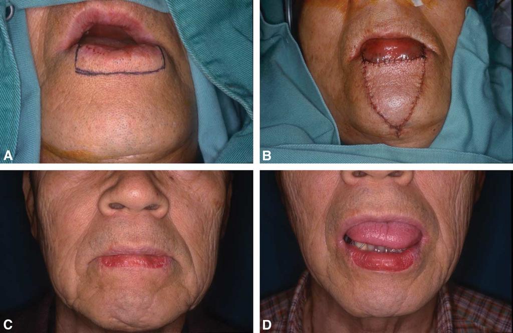 Combined tongue flap and V Y advancement flap for lower lip defects 261 Figure 3 (A) Squamous cell carcinoma marked to be resected, (B) V Y flap was advanced to the defect and distal undersurface