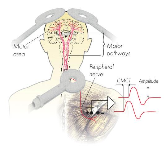 utic Advanced therapeutic variant is targeted at highfrequency stimulation templates (20 Hz, 50 Hz and even 100 Hz) owing to extra power supply unit.