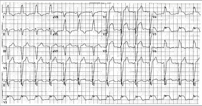 abnormalities Age of Q-waves (may not be known) Paced ventricular rhythm Left bundle branch block Right bundle branch block: secondary ST-T abnormalities in V 1-3 can mimic anterior wall MI; tall R