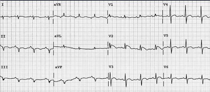 HYPERKALEMIA vs ANTERIOR OR INFEROPOSTERIOR WALL MI vs 15 16 Type 1 Type 1 Type 1 (Coved ST segment elevation >2mm in >1 of V1-V3 followed by a negative T wave) is the only ECG abnormality that is