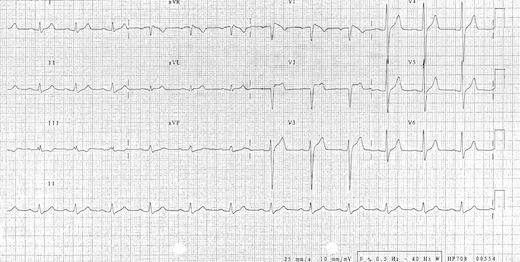 Type 2 Type 2 Type 2 has >2mm of saddleback shaped ST elevation. 19 20 Type 3 Type 3 Brugada type 3 can be the morphology of either type 1 or type 2, but with <2mm of ST segment elevation.