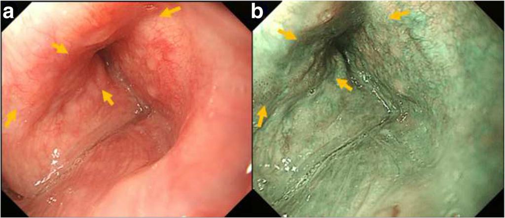 Nakamura et al. BMC Cancer (2016) 16:743 Page 3 of 8 Fig. 1 Endoscopic finding of superficial HNSCC in right piriform sinus. a White light imaging. Detection of lesion was difficult.