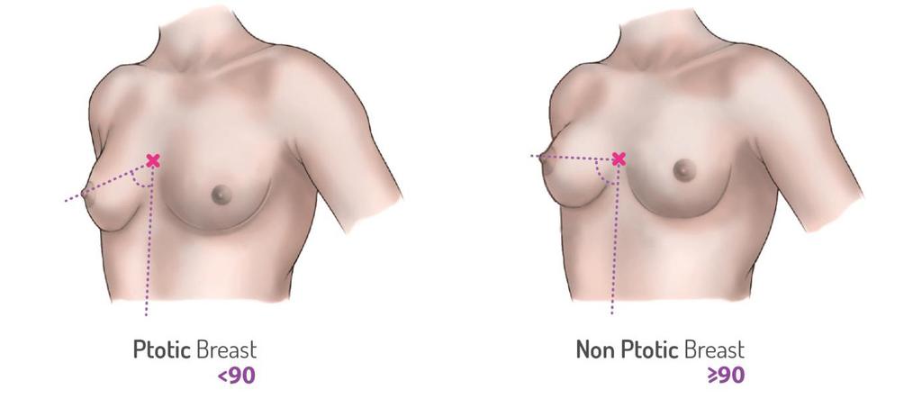 RESULTS From January 2010 to September 2017, 300 patients presenting for breast lift, mastopexy or breast reduction were analyzed and treated with various surgical techniques.