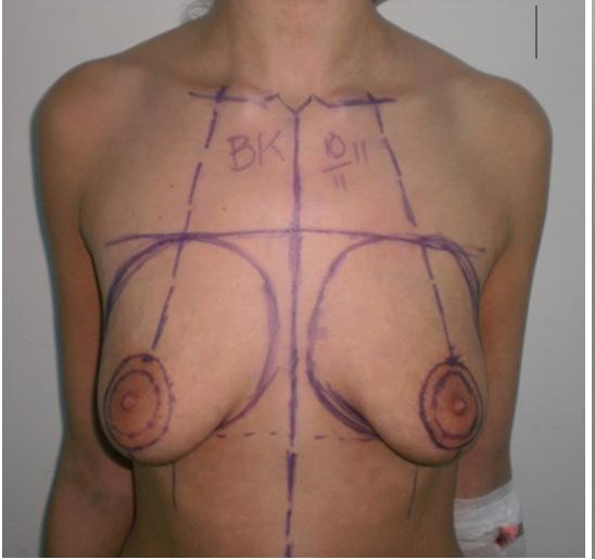 treatment A B C Figure 5. (A) A 25-year-old woman asking for a breast augmentation.