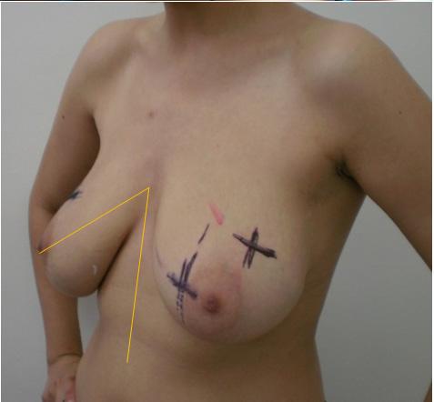 a vertical breast lift approach was performed with multiple fibroadenomas resections.