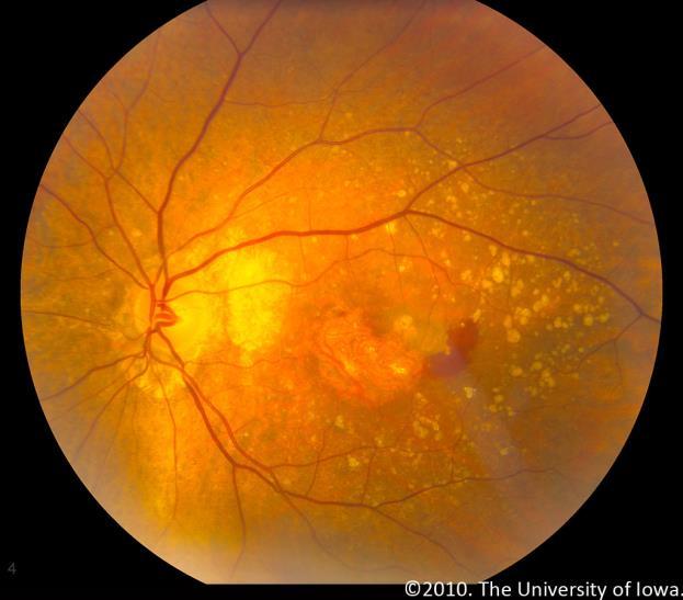 Neovascular ( wet ) AMD usually responds well to intravitreal anti-vegf medications, which has