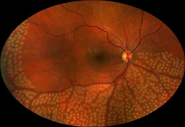 Diabetic retinopathy what s old?