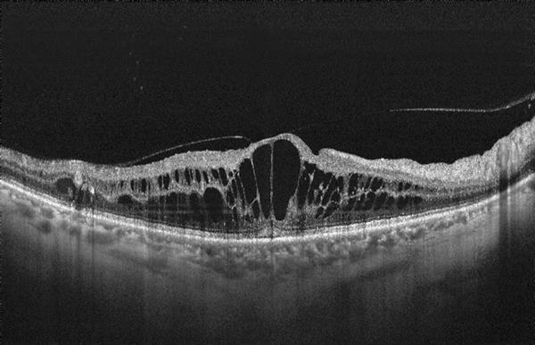 Diabetic retinopathy what s new?