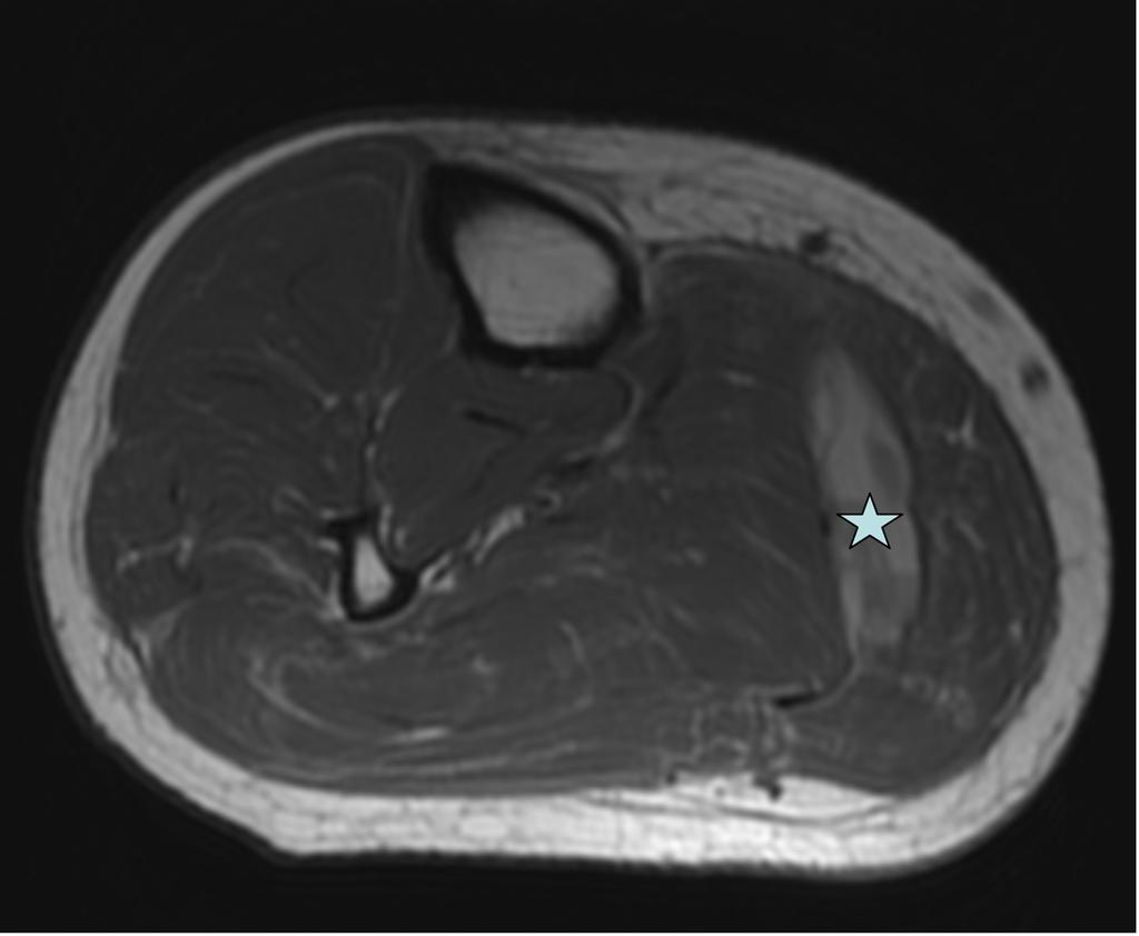 Fig. 6: T1 axial image showing haematoma (star) between the