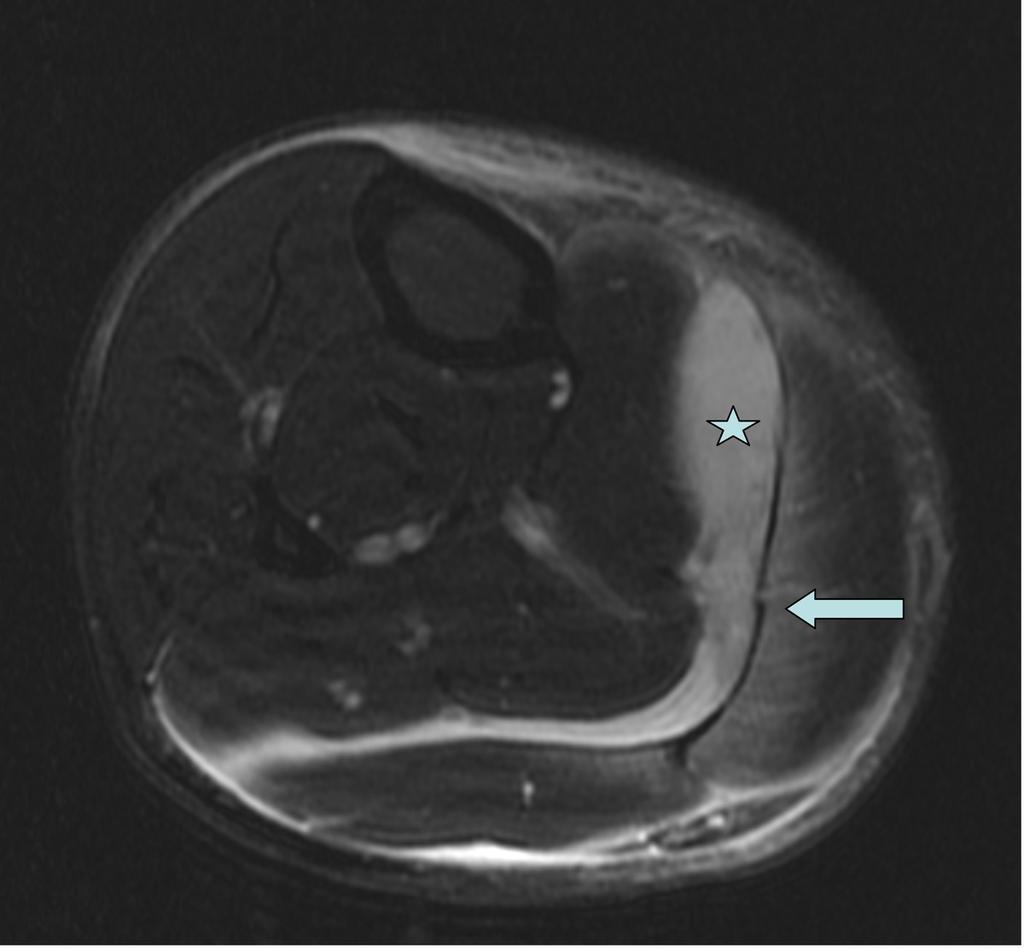 Fig. 7: T2FS axial image showing collection (star) between the medial head of gastrocnemius and