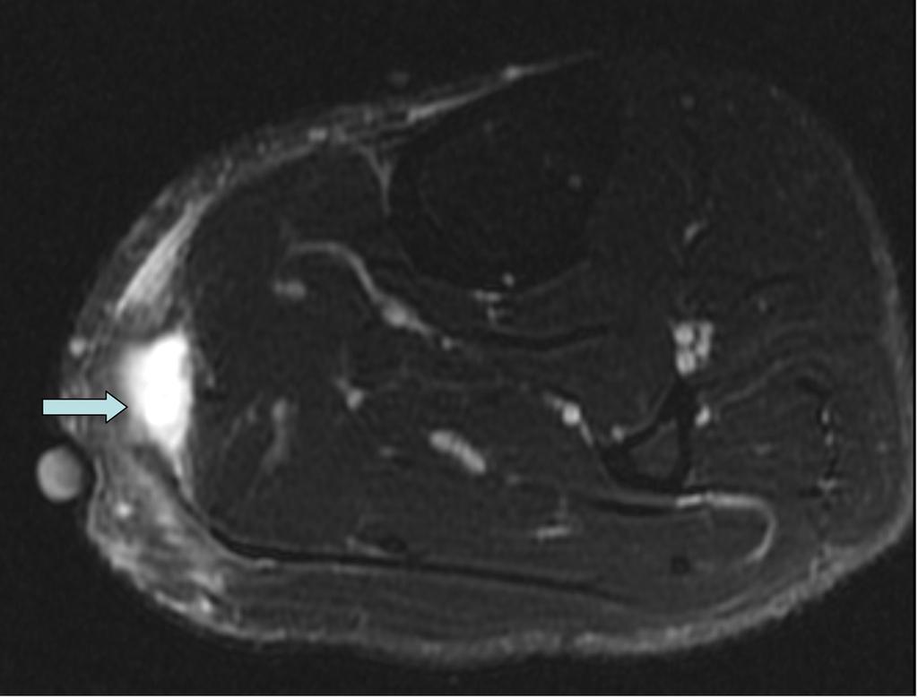 Fig. 9: T2FS axial image showing tear at the myotendinous