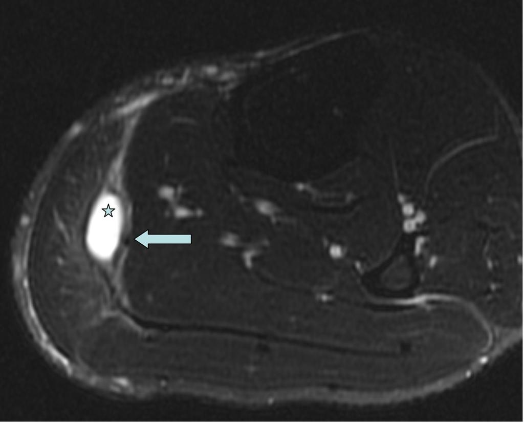 Fig. 10: T2FS axial image showing collection (star) between the medial head of