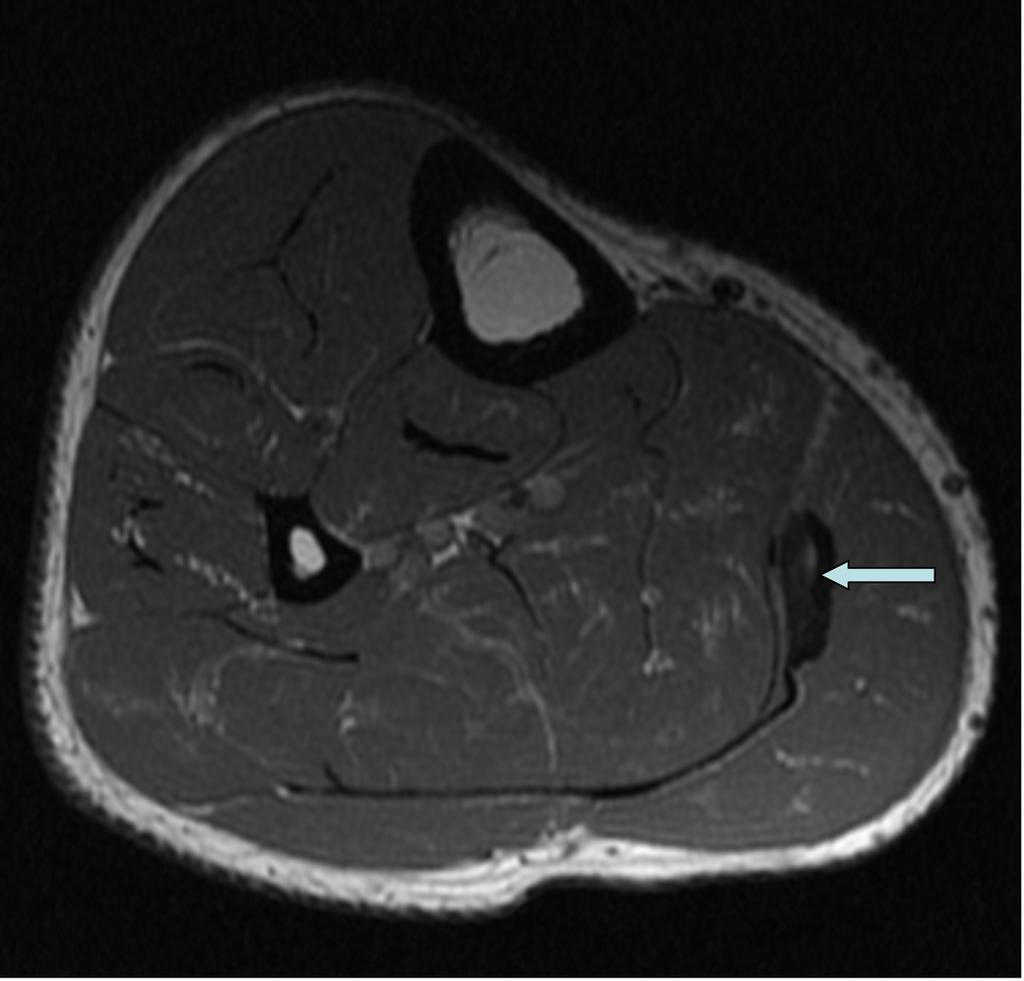 Fig. 11: T1 axial image showing chronic haematoma (arrow) between