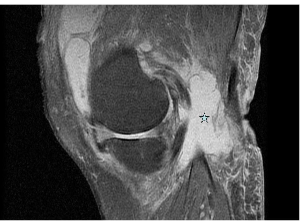Fig. 12: PDFS sagittal image showing ruptured Bakers cyst