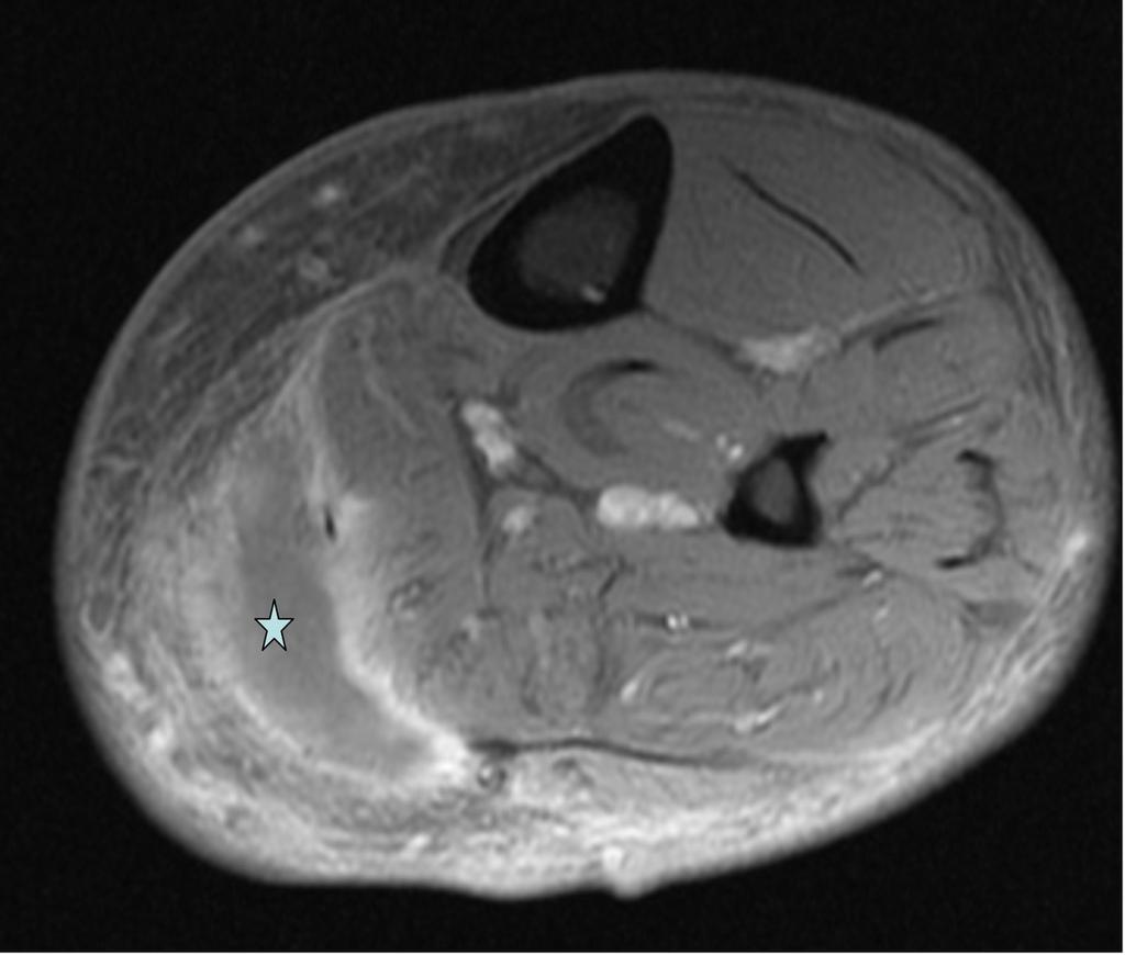 Fig. 13: T1FS post contrast image showing abscess (star) with peripheral enhancement between the