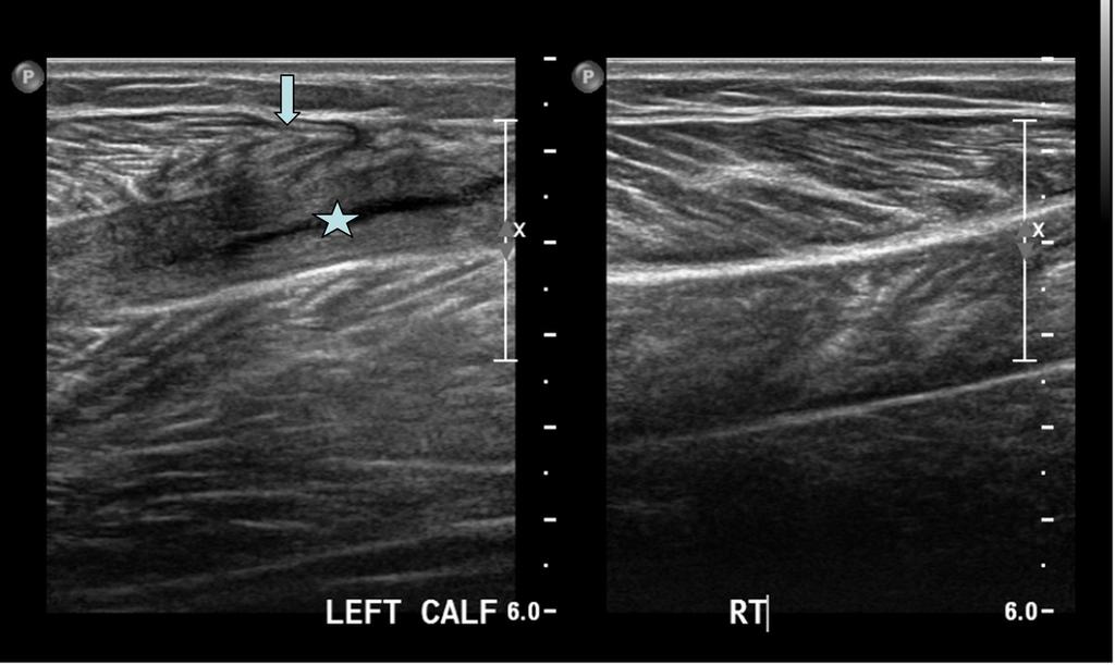 Fig. 3: Another patient ultrasound image longitudinal section through the calf region showing chronic haematoma (star) between the medial