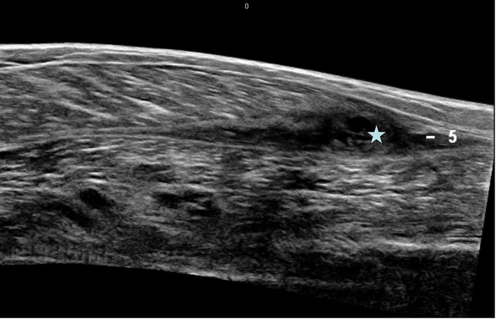 Fig. 4: Ultrasound longitudinal section.