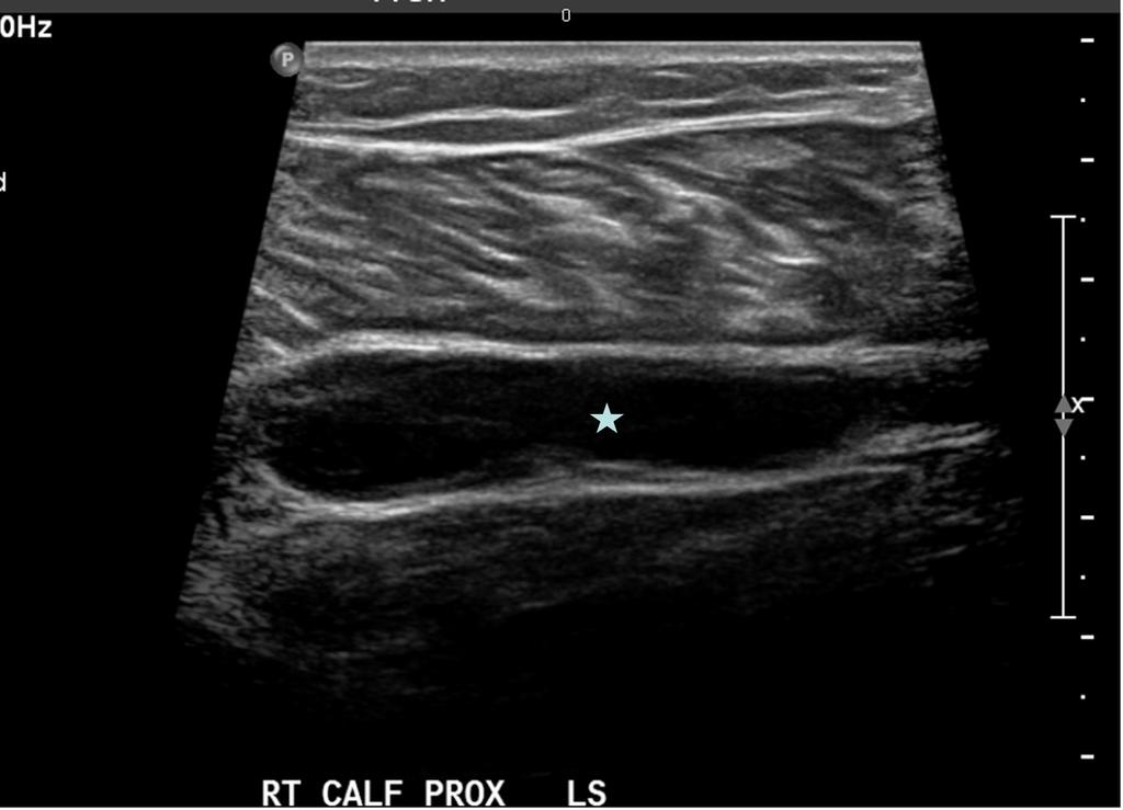 Fig. 5: Ultrasound image longitudinal section through the calf region showing collection(star) between the medial head