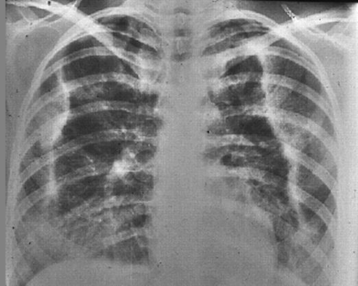 CEP: Chest Radiographs Infiltrate of