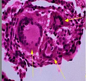 Cells Granulomas