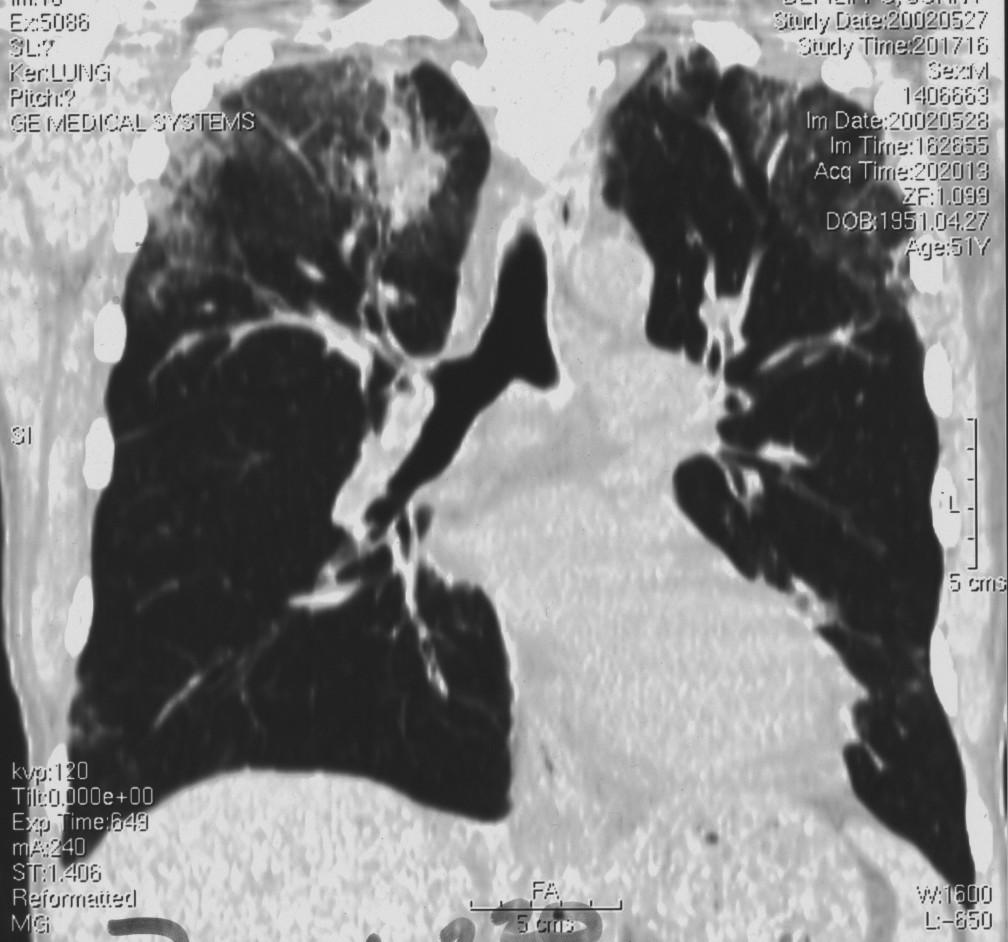 presents with respiratory distress, tender subcutaneous nodules on the