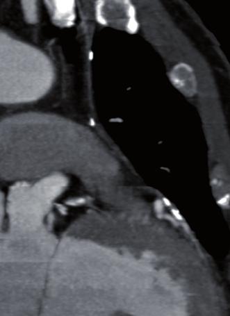 The right internal mammary artery (RIMA) is more commonly used as an arterial free graft, with the proximal anastomosis removed from the subclavian artery and attached on the ascending aorta.