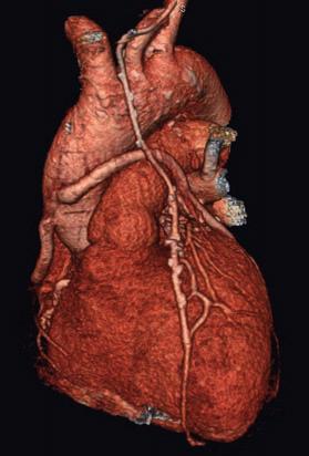 Review Ascarelli, Francone, Cannata, Cannavale, Carbone & Passariello Figure 4. A 58-year-old male patient with triple coronary artery bypass grafts.