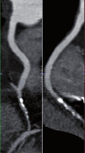 MDCT visualization of the radial artery may be hampered by artifacts from the surgical clips used to close the numerous collaterals of this muscular artery.