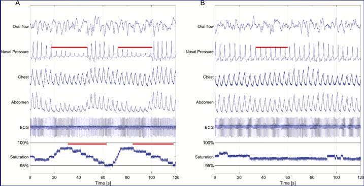 Twin Study Reveals Heritability of Arousal Responses and Heart Rate Response to Arousals (Gao X, et al, Sleep 2017 Jun 1;40(6). doi: 10.1093/sleep/zsx055) Estimates Heritability HR as arousal 5 0.