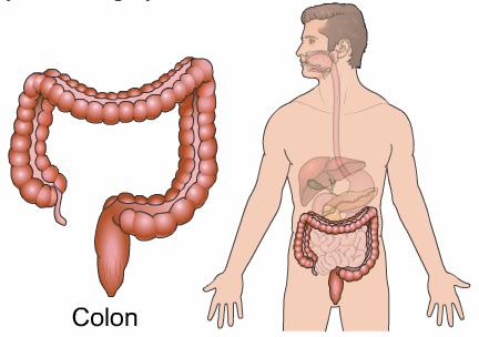 Colon Cancer Introduction Colon cancer is fairly common. About 1 in 15 people develop colon cancer. Colon cancer can be a life threatening condition that affects the large intestine.