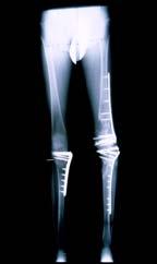 LISS System Femur & Tibia 42-year-old, complex tibial shaft fracture C3, open 6 mo. postop N., W., 23 y.