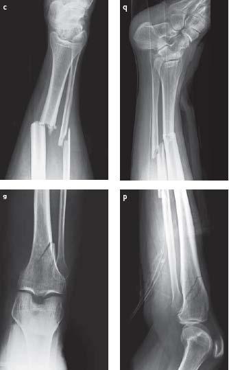 from Michael Wagner, Wien Open tibial shaft fracture, 42-C2 (slide 1 of 2) 50-year-old man, skiing injury