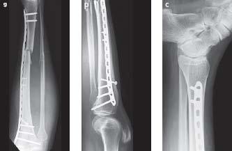 reduction and fixation postoperative x-rays Simple metaphyseal fracture Principle: absolute stability
