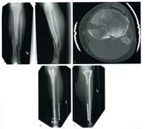 Unicondylar tibial plateau fracture and shaft fracture Screw / plate