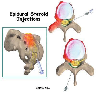 Introduction Epidural steroid injections (ESI) are commonly used to control back and leg pain from many different causes.