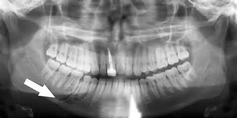 Fracture of mandible or maxilla A fracture involving the base of