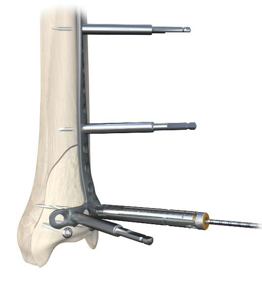 Section A: Anterolateral Distal Tibia Locking Plate Screw Insertion Proceed with definitive fixation of fracture using appropriate screw selections.