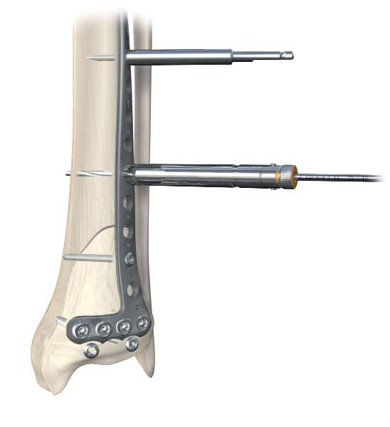 Section A: Anterolateral Distal Tibia Locking Plate Remove the provisional fixation pins and complete definitive fixation with the insertion of 3.5mm Locking Self-Tapping Cortex Screws.