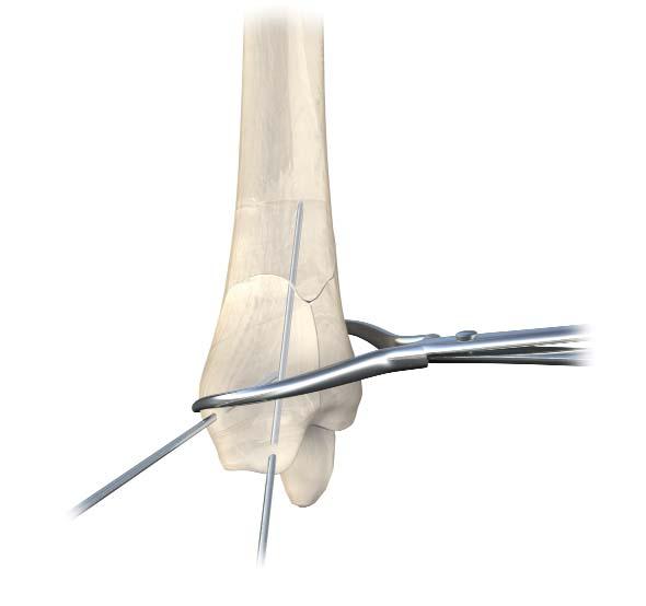 Section B: Medial Distal Tibia Locking Plate Articular Reduction and Provisional Fixation It is