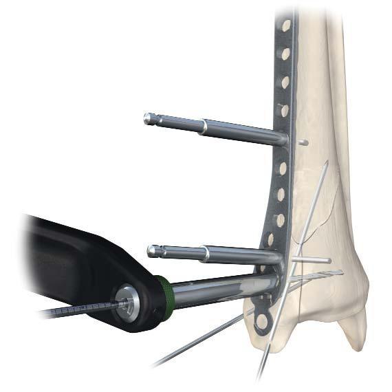 Section B: Medial Distal Tibia Locking Plate Screw Insertion Proceed with definitive fixation of fracture using appropriate screw selections.