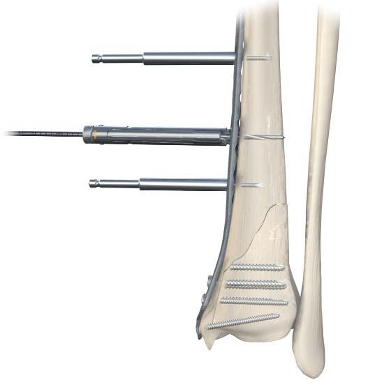 Section B: Medial Distal Tibia Locking Plate To insert locking screws in the diaphysis, place the 3.5mm Locking Screw Guide with the 2.