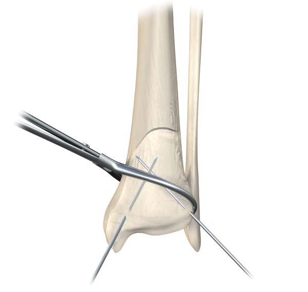 Section A: Anterolateral Distal Tibia Locking Plate Articular Reduction and Provisional Fixation It is important that articular fracture reduction be obtained prior to placement of locking screws.