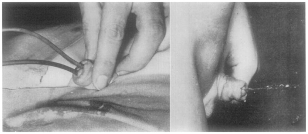 --Distal part of dorsal urethra reconstructed using Denis Browne procedure (Fig. 2). Small fistula in dorsal urethra followedm2 cm. from tip of penis (Fig. 3). FIG. 2 Fro. 3 Fig. 2.--1952.