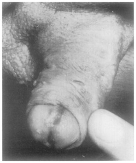 Penis showing normal glandular meatus, dorsal urethral meatus, dorsal urethral fistula. FIG. 4 Progress.