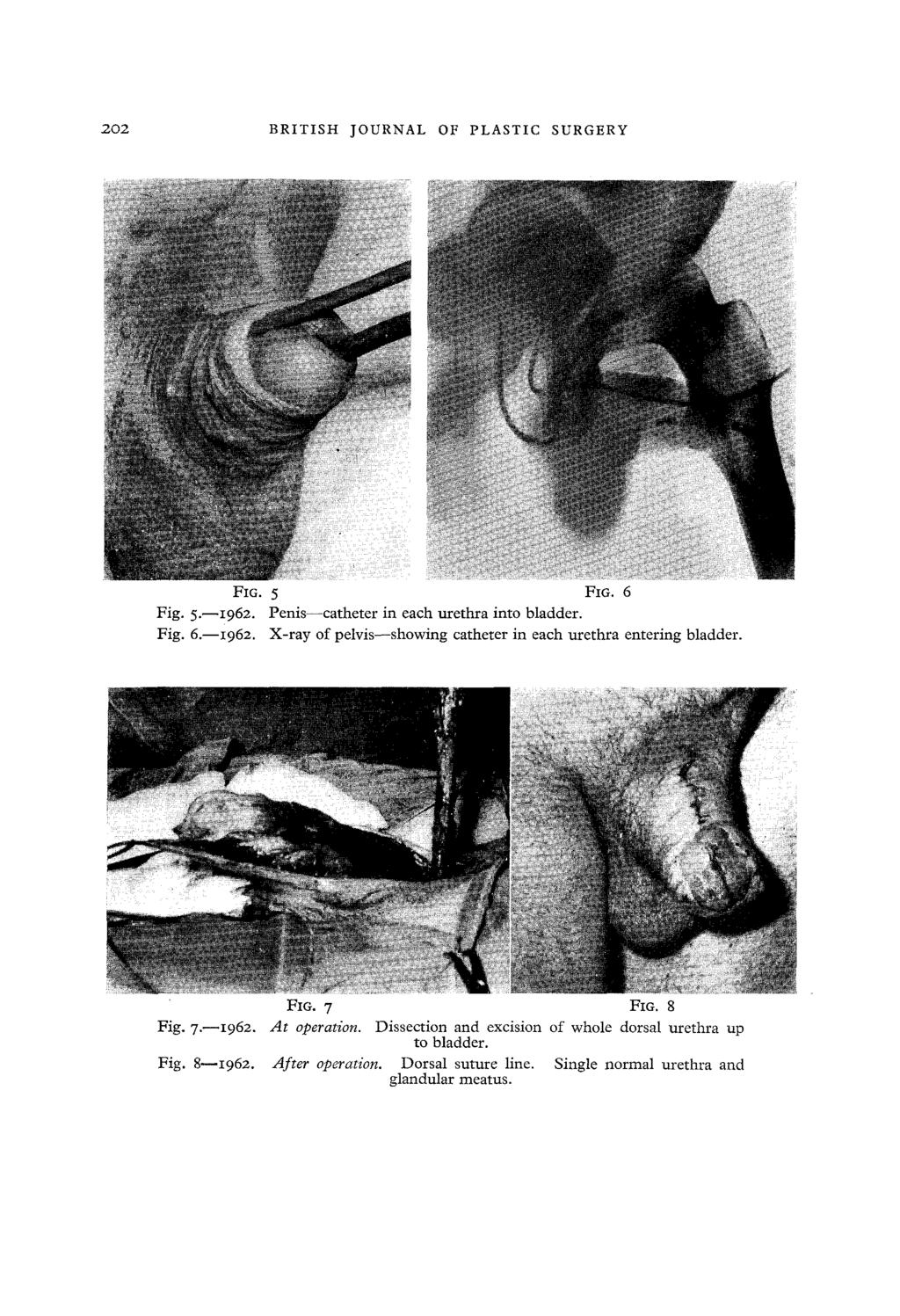 202 BRITISH JOURNAL OF PLASTIC SURGERY FIG. 5 FiG. 6 Fig. 5.--I962.