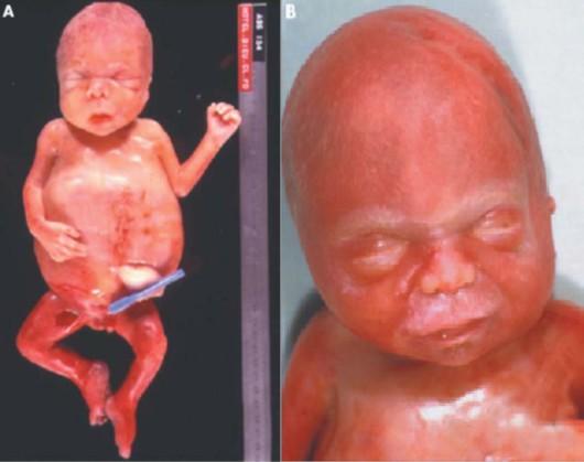 Salla disease is onset at 12-18 months, occurs in both sexes and is ethnic specific to Finland and Sweden (Wynbrandt, & Ludman M.D., 2008).