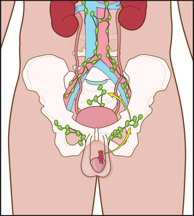 Kidney Aorta Pelvic Pelvic lymph nodes Inguinal lymph nodes Cancer 2017 patients.uroweb ALL RIGHTS RESERVED Fig. 3: Penis tumour with regional spread.